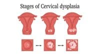 Cervical Dysplasia - Dr Sandra Cabot MD