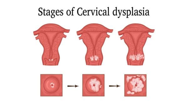 cervical-dysplasia-dr-sandra-cabot-md