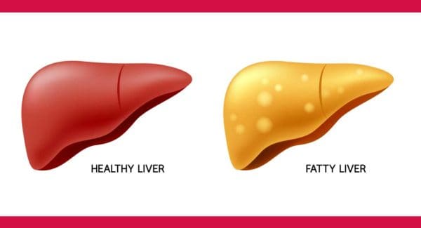 Fatty Liver - Dr Sandra Cabot MD