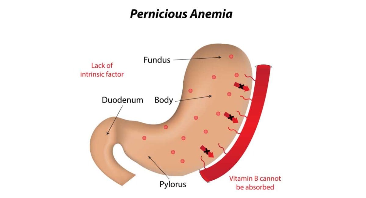 Pernicious Anemia Dr Sandra Cabot MD