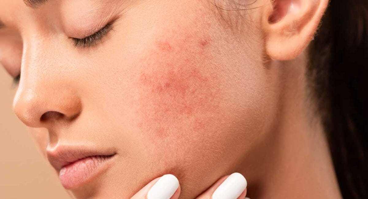 How To Deal With Acne Vulgaris Dr Sandra Cabot Md